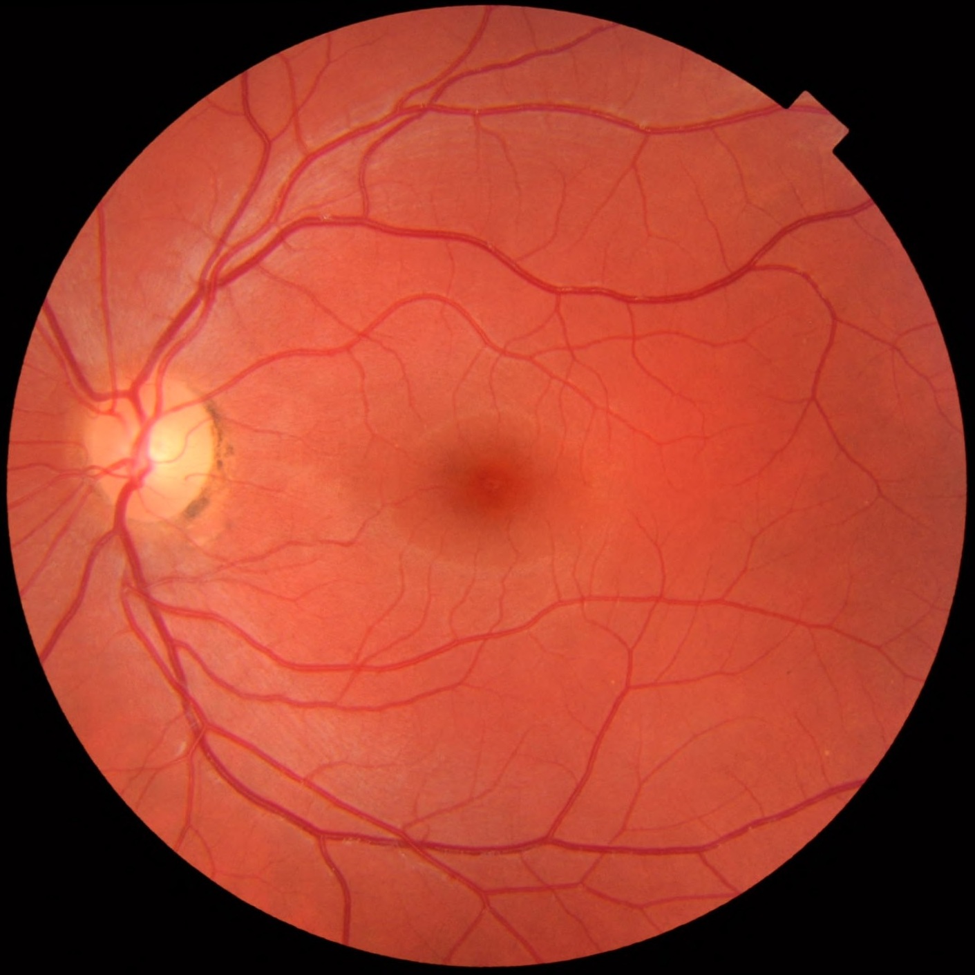 Illustrative fundus photograph showing the retina and optic disc of a normal left eye